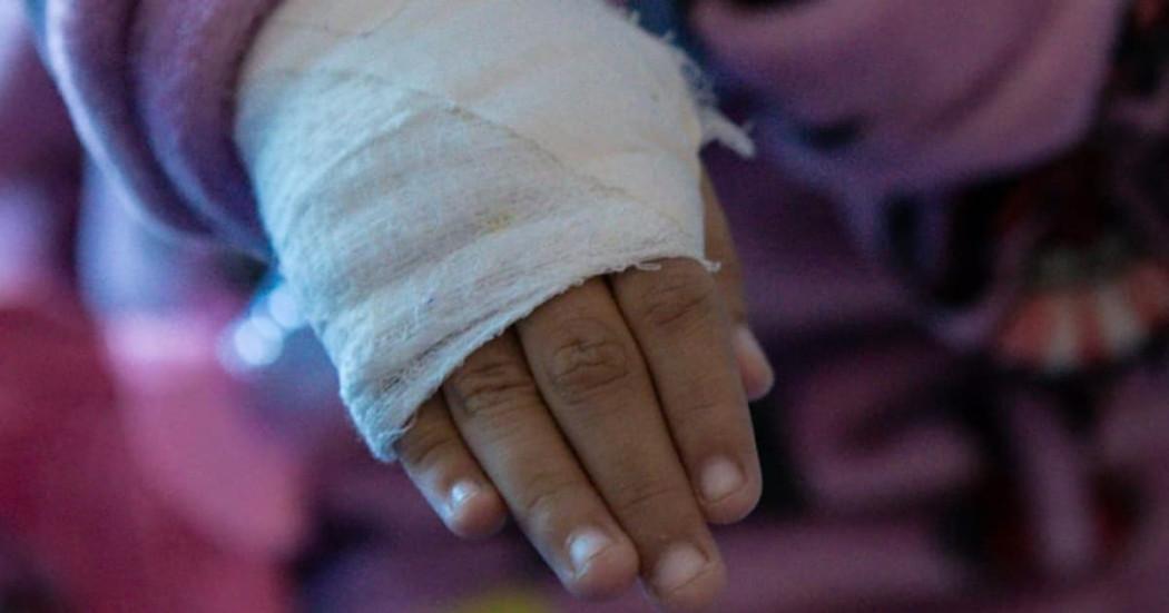 Niño indígena sufrió quemadura con liquido Universidad Nacional Bogotá